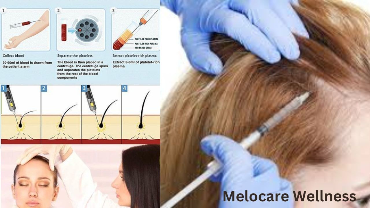 Best PRP Treatment in Delhi Melocare wellness