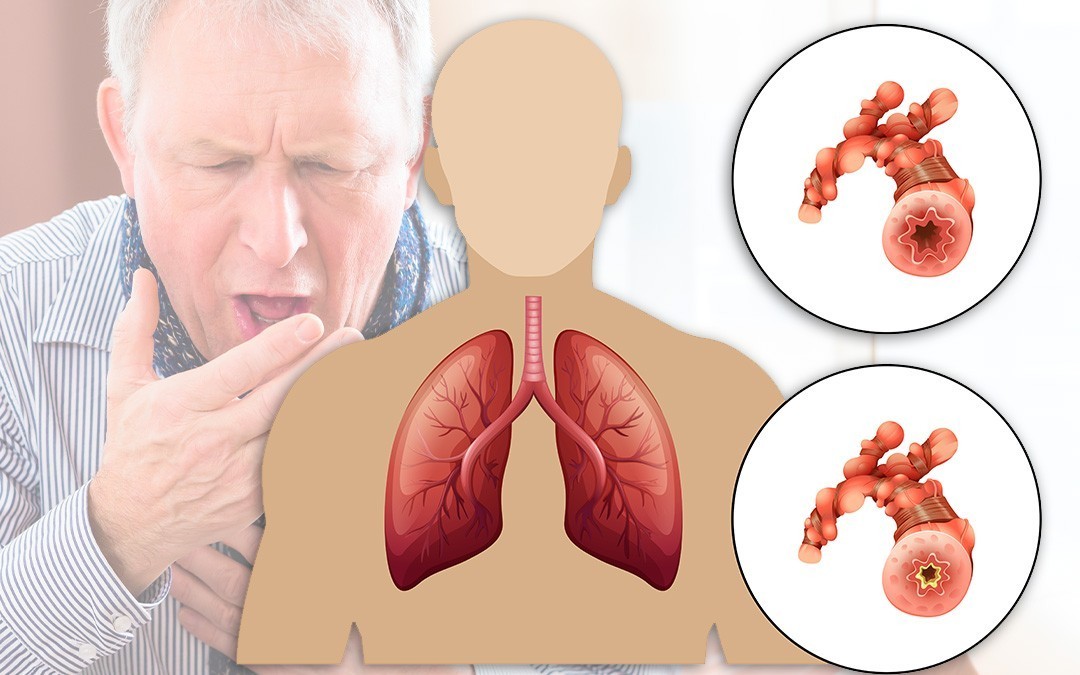 HOW I GOT CURE OF MY COPD and Hepatitis b BY DR WILLIAM